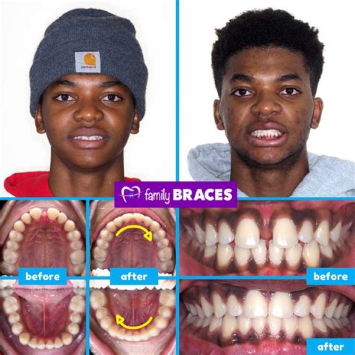 
Shooting Stars Actor Caleb McLaughlin Teeth Before And After: Has He Used Braces And Whitening? 